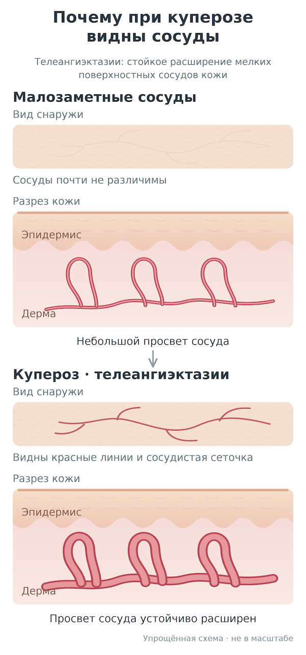 Схема: при куперозе мелкие сосуды кожи стойко расширены и становятся видны
